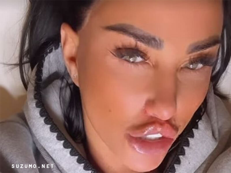 ริมฝีปากผีเสื้อของ Katie Price
